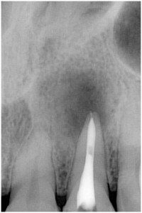 藤本２　根管充填